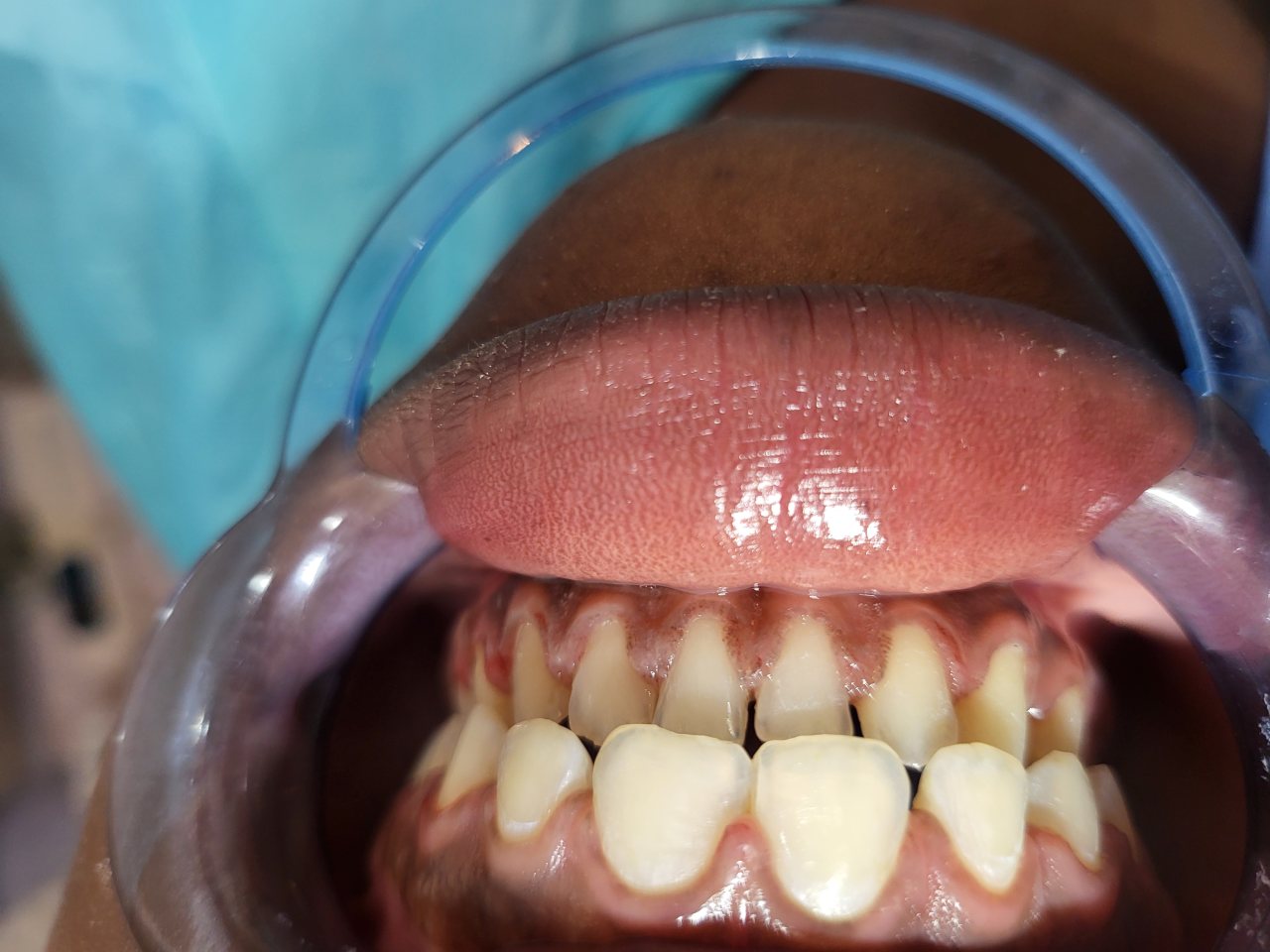 Fin de soin orthodontie. Cette patiente a désormais un sourire Glorieux — après