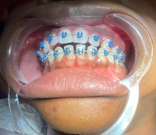 Fin de soin orthodontie. Cette patiente a désormais un sourire Glorieux — avant