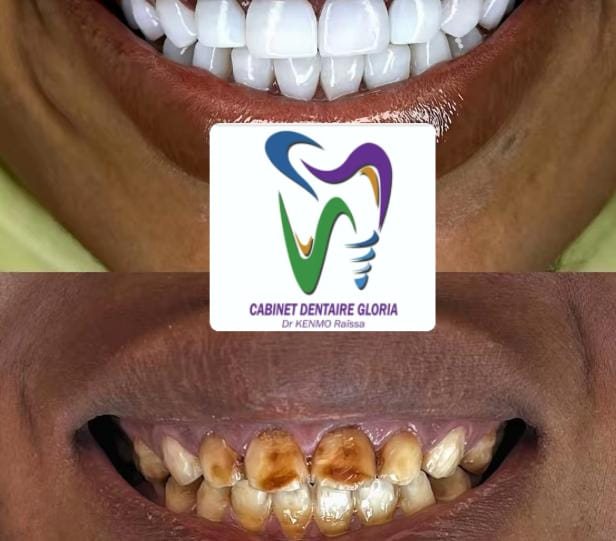 Sourire Hollywoodien à Douala Grâce aux Facettes Dentaires en Composite